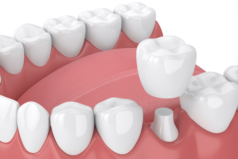 Dental Crowns in Greenville