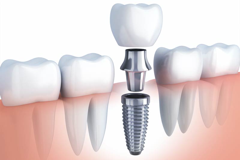 Implants Dentist in Greenville