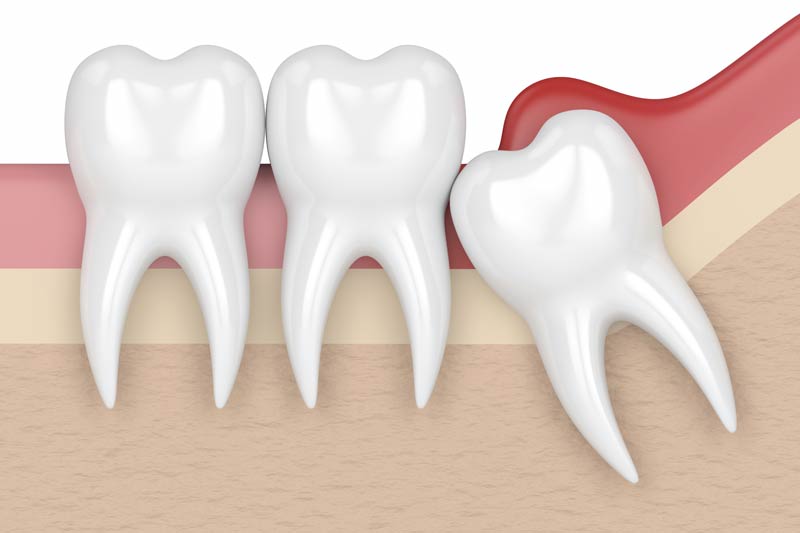 Wisdom Tooth Removal in Greenville